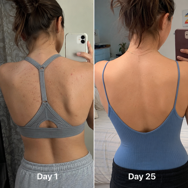 I've had back acne since my twenties